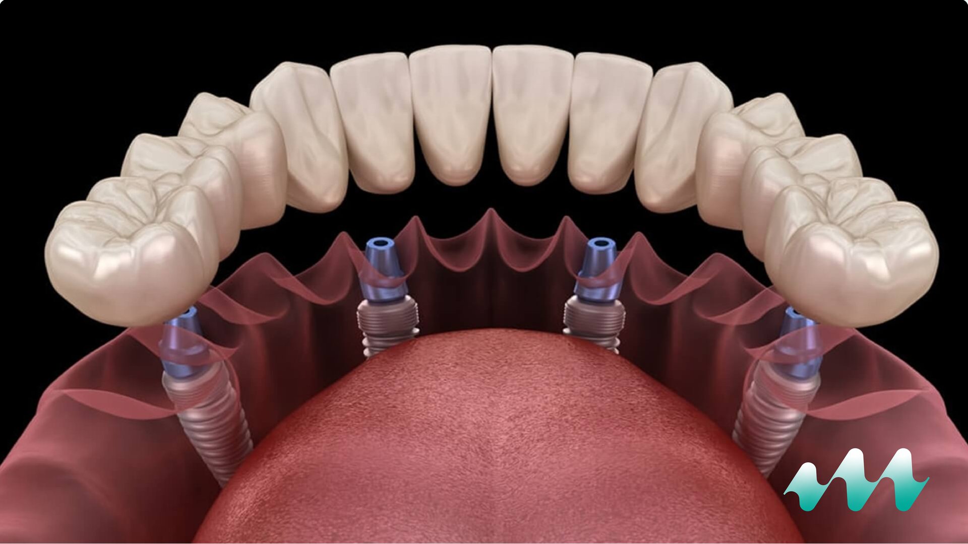 All-on-4 dental implant treatment restoring a full arch of teeth at Medicape Health