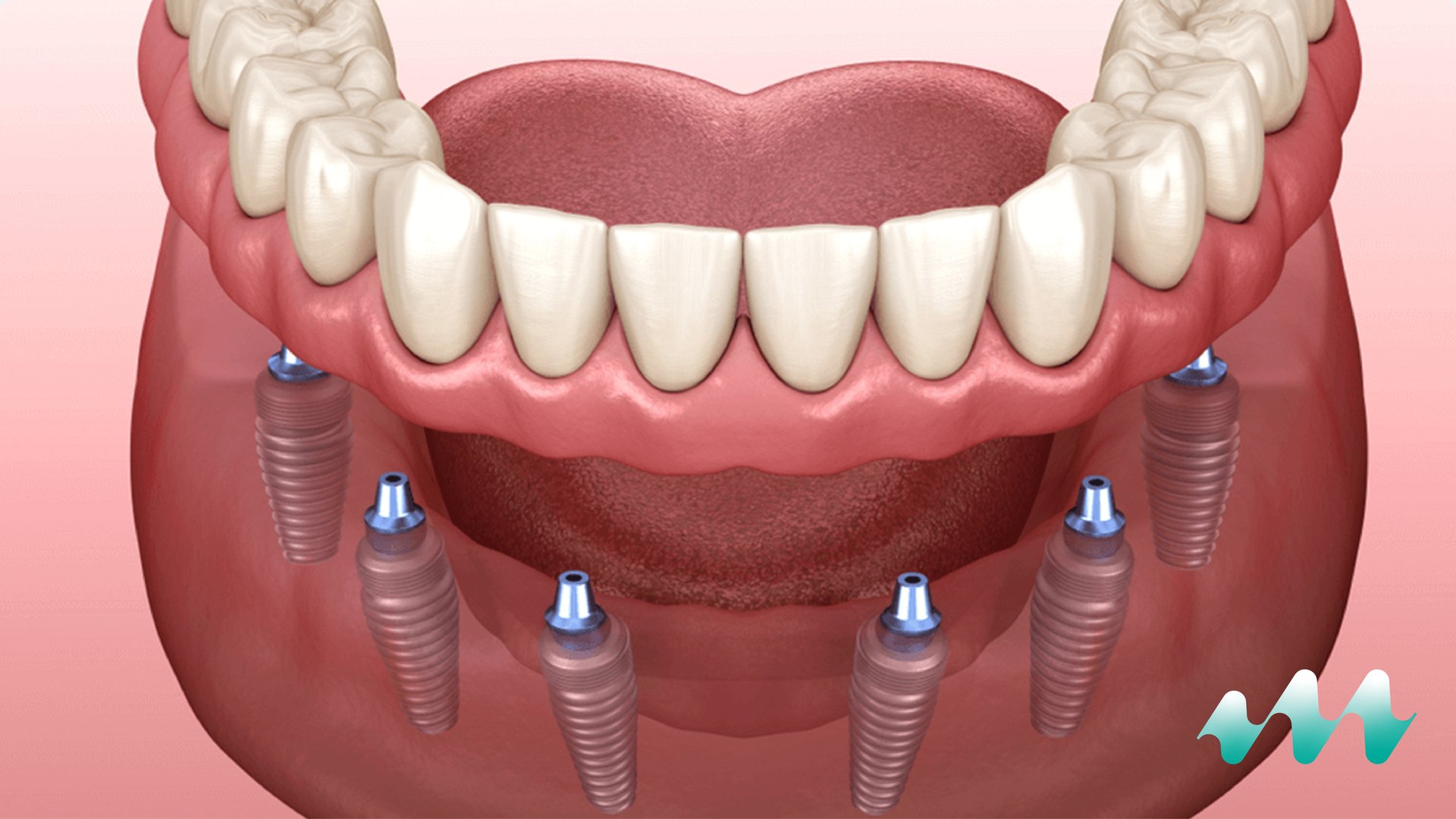 Dental implant treatment visual for the Medicape Health implantology category