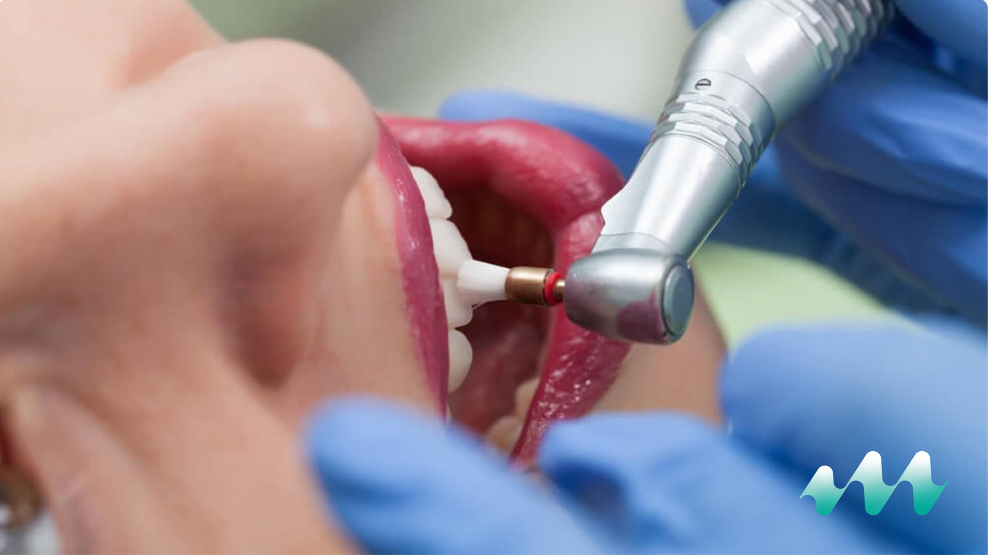 Professional dental cleaning and tartar removal treatment at Medicape Health in Turkey