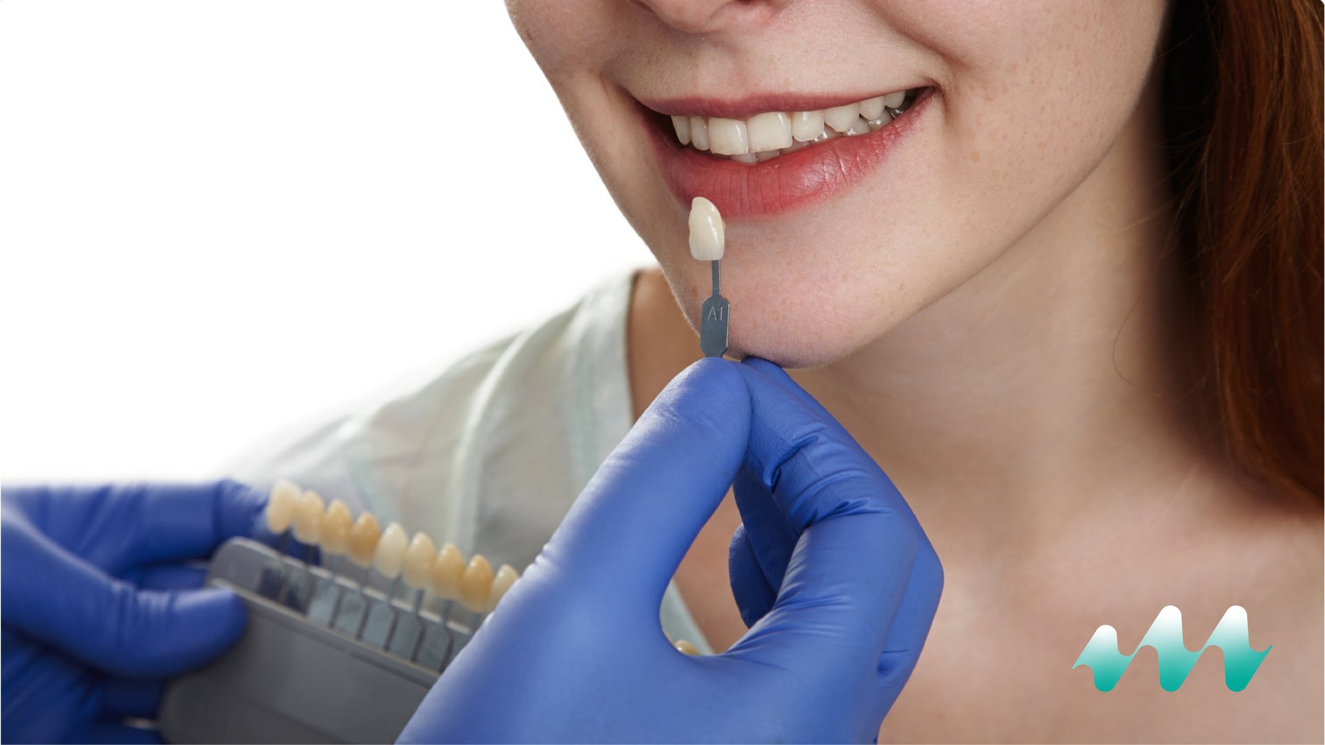 Shade matching for E-max lithium disilicate veneers at Medicape Health in Turkey