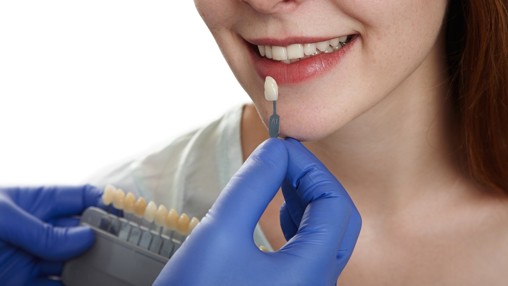 Shade matching for E-max lithium disilicate veneers at Medicape Health in Turkey