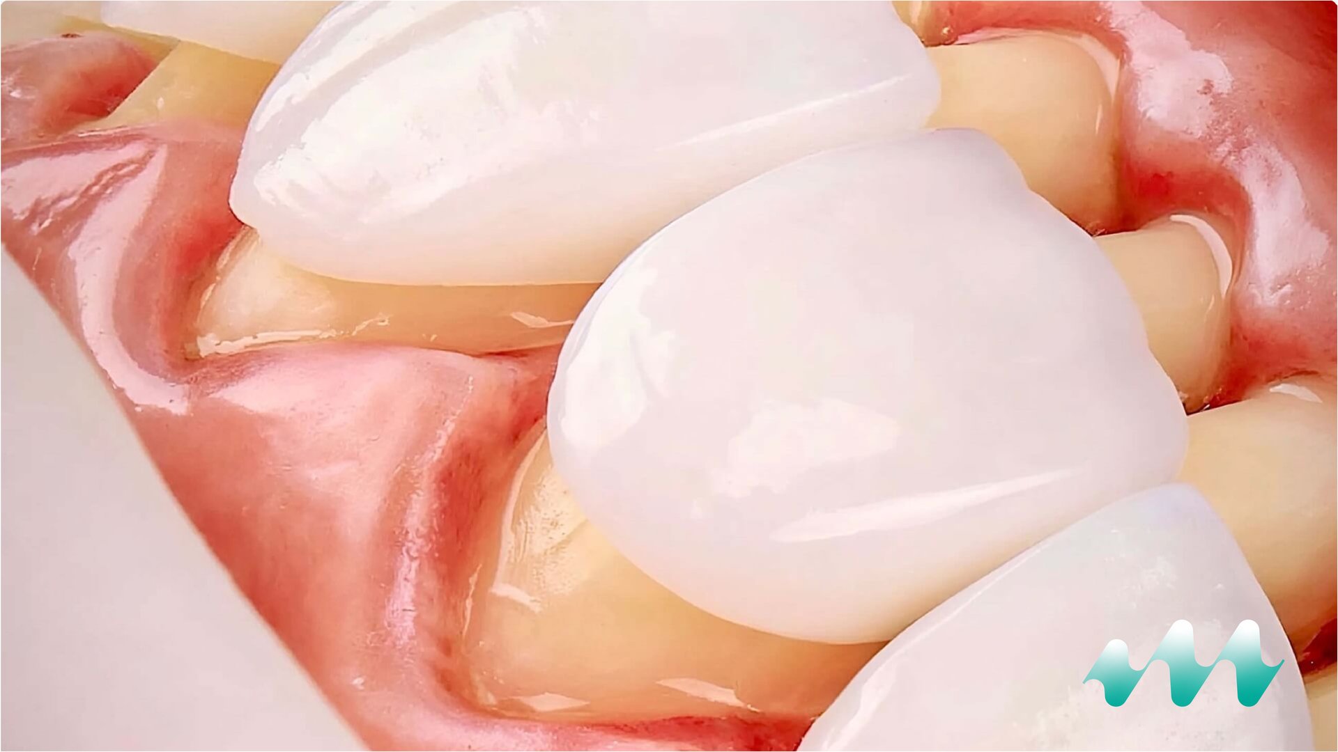 Porcelain laminate veneers applied in cosmetic dental treatment at Medicape Health