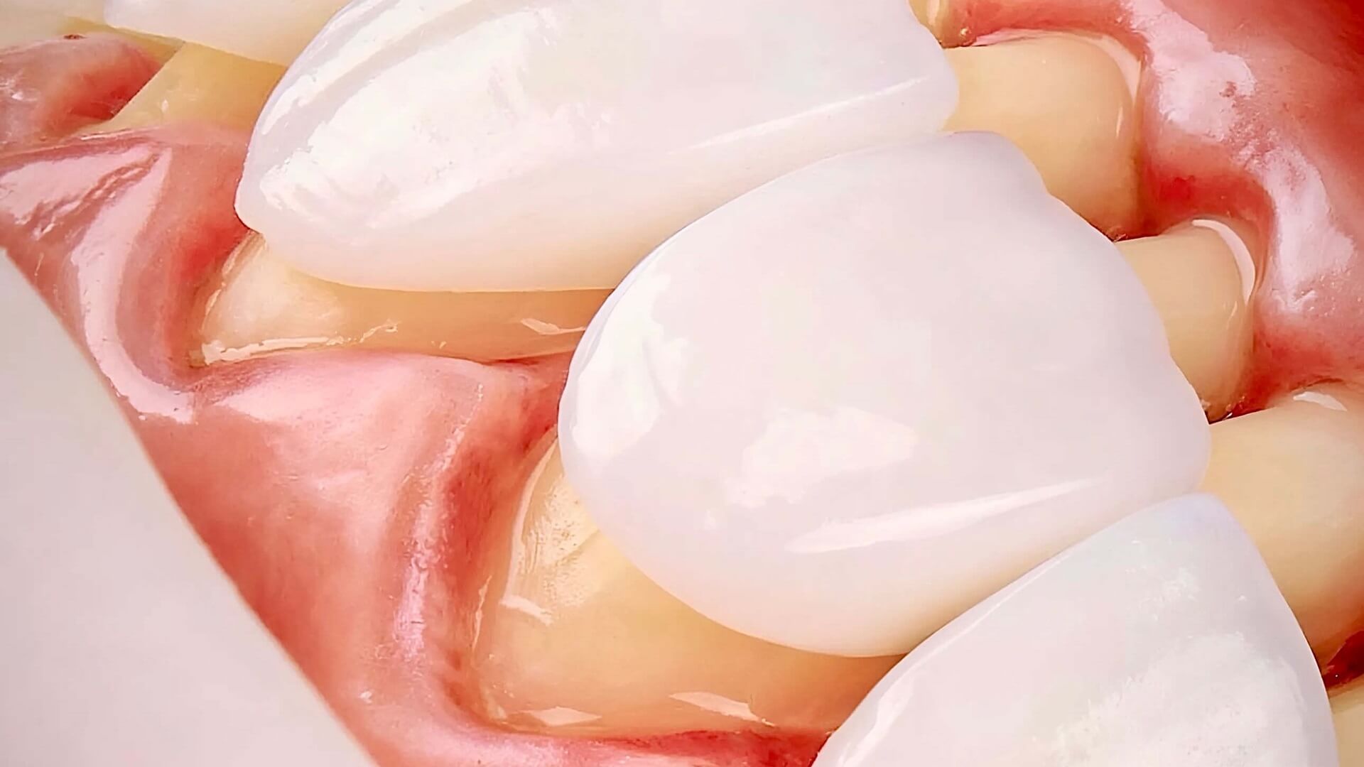 Laminate Dental Treatment