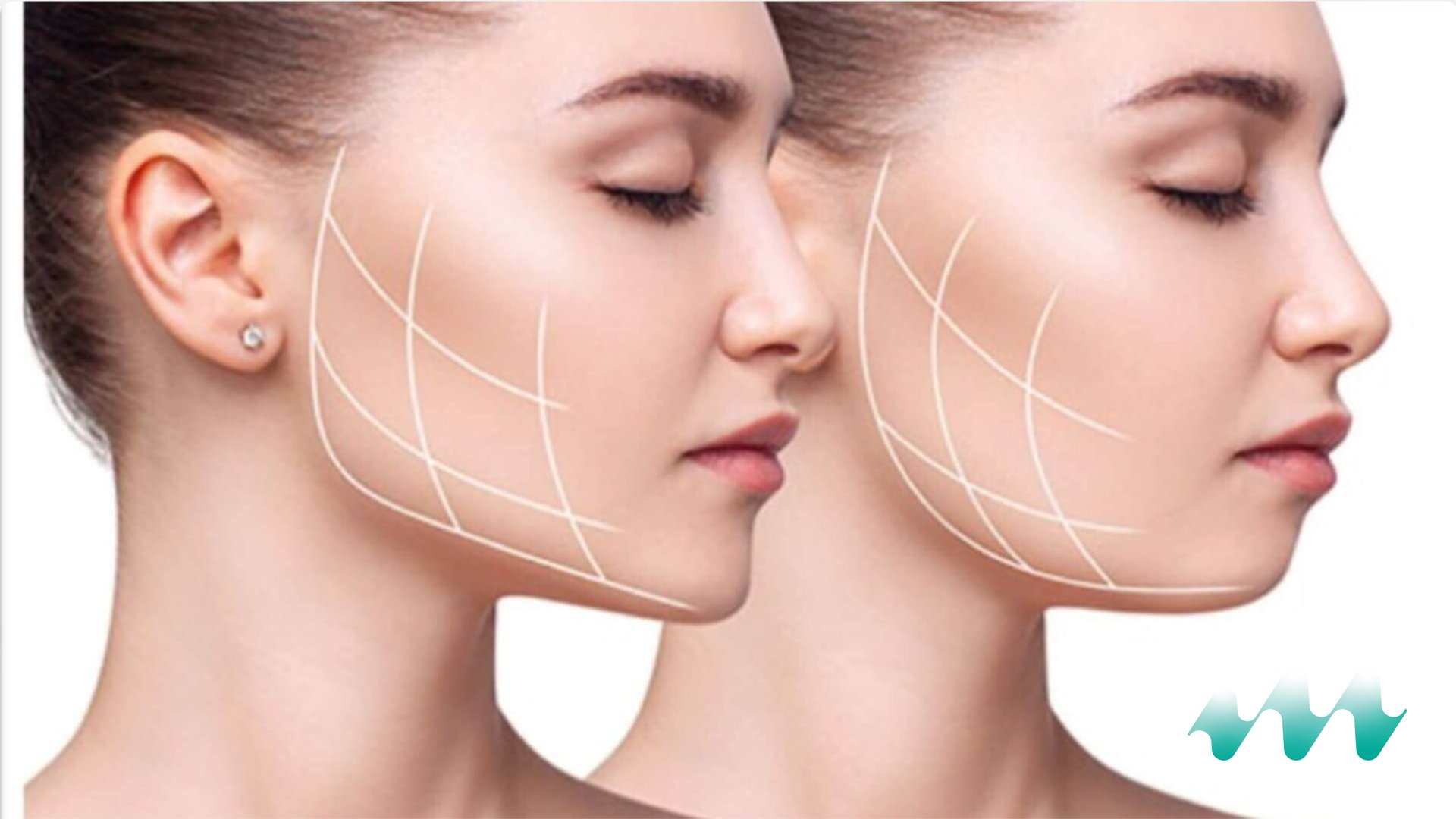 Masseter Botox application for jawline slimming and bruxism relief at Medicape Health