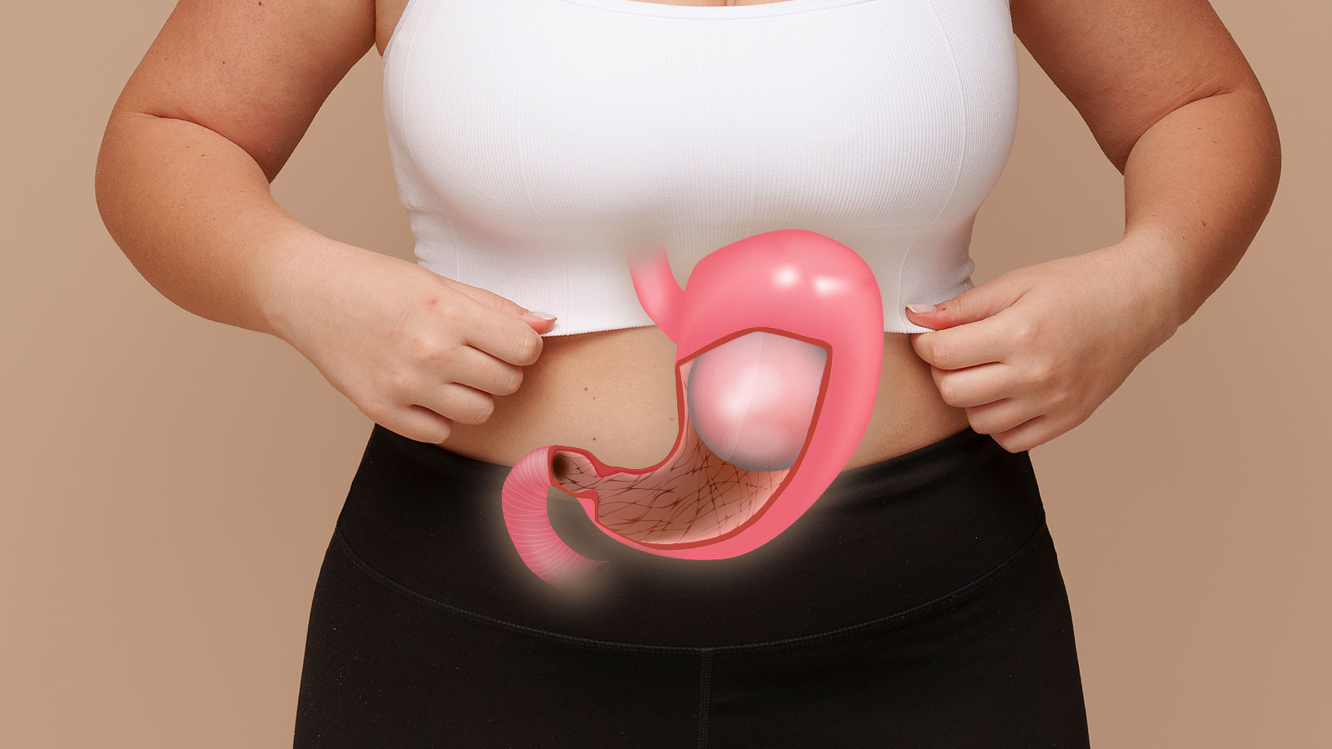 Gastric Balloon