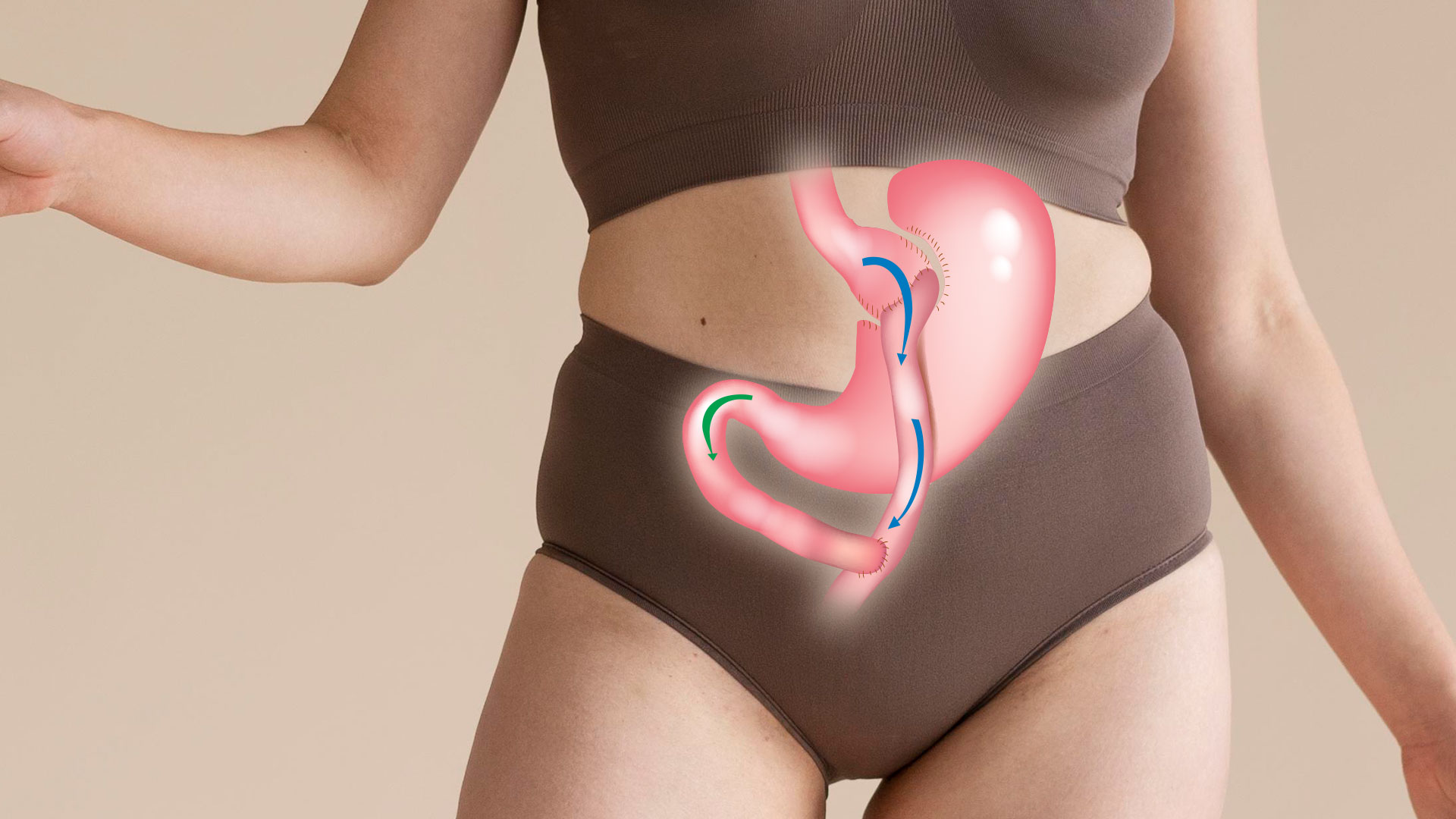Gastric Bypass Surgery
