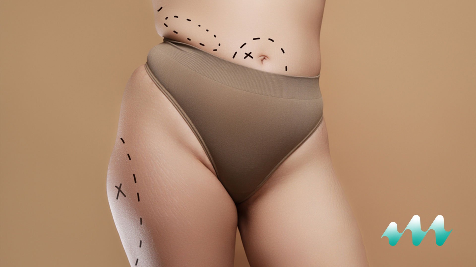 Liposuction