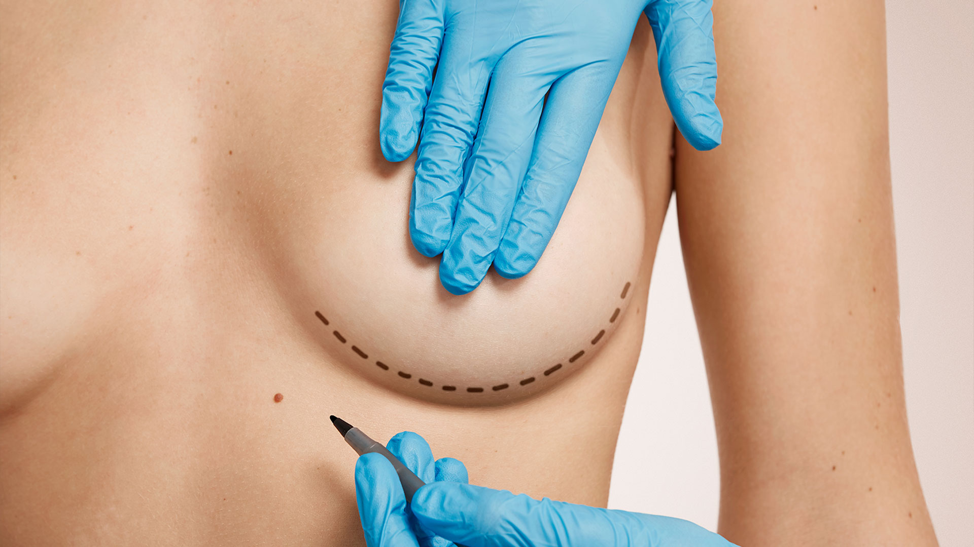 Breast Reduction
