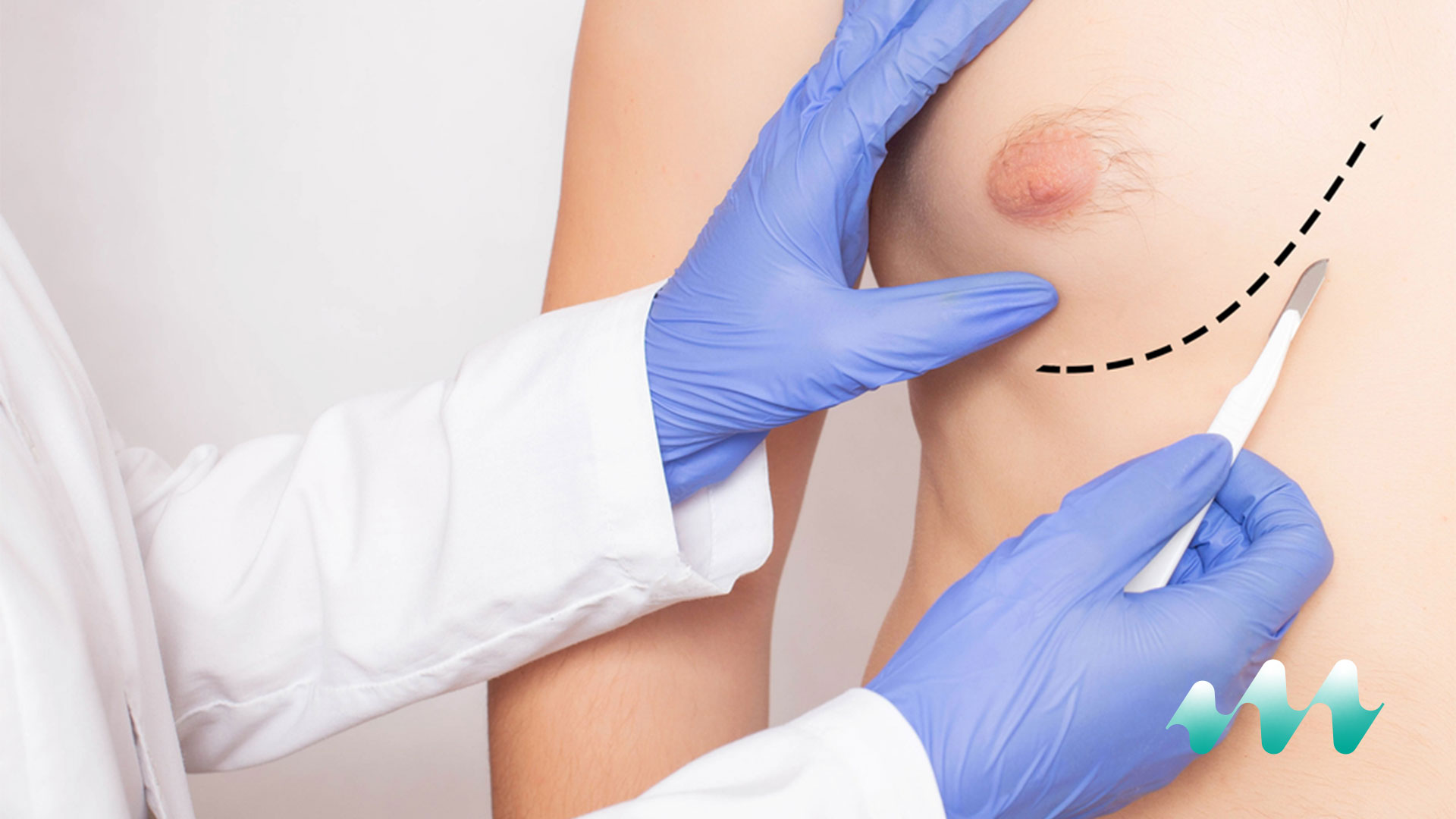 Gynecomastia